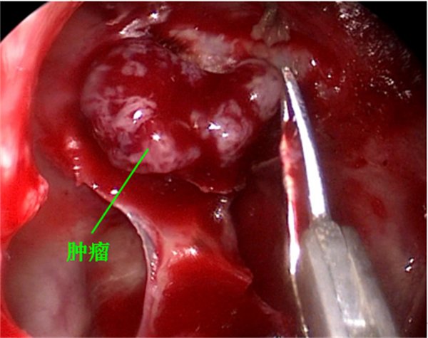 不开颅，鼻孔里面“夹出”肿瘤1763.png
