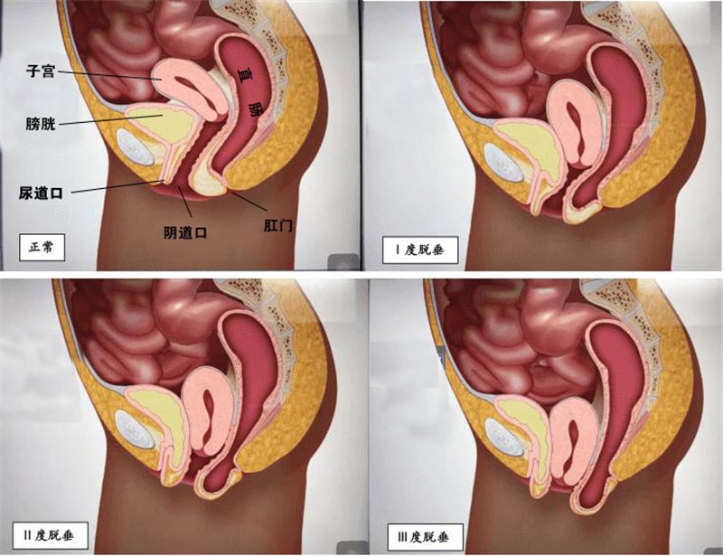 子宫及阴道前后壁脱垂示意图.png