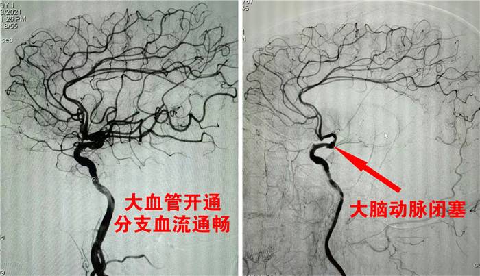 术前术后血管造影对比1.jpg