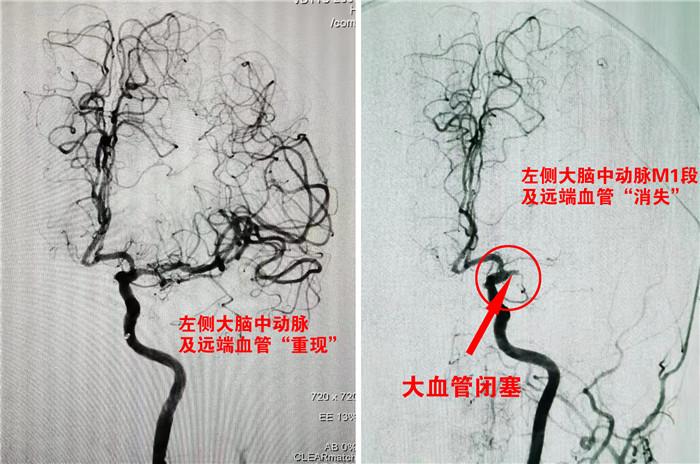 术前术后血管造影对比.jpg