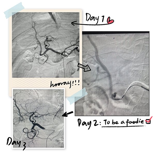 血管介入术前术后.jpg