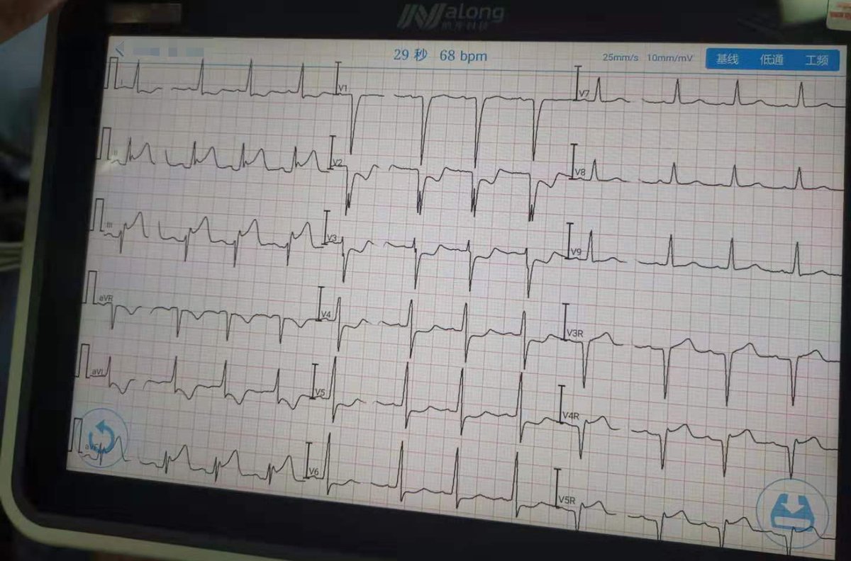 传至胸痛中心微信群的首次心电图.png